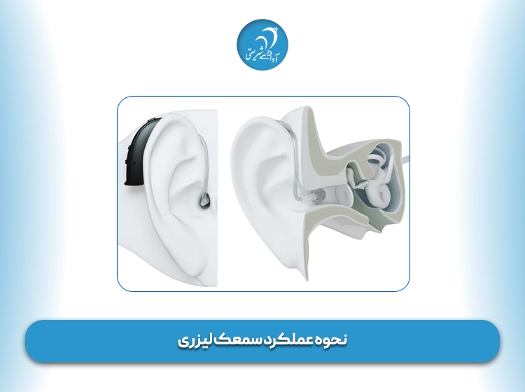 نحوه عملکرد سمعک لیزری