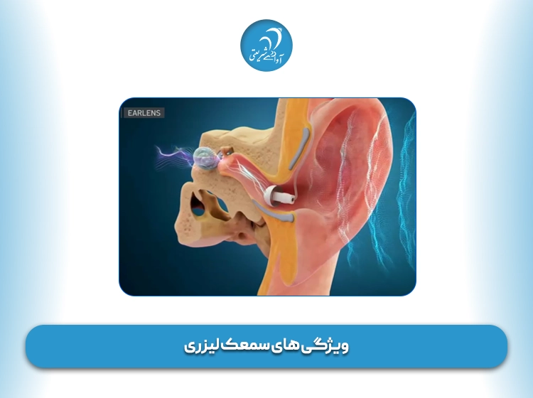 ویژگی های سمعک لیزری