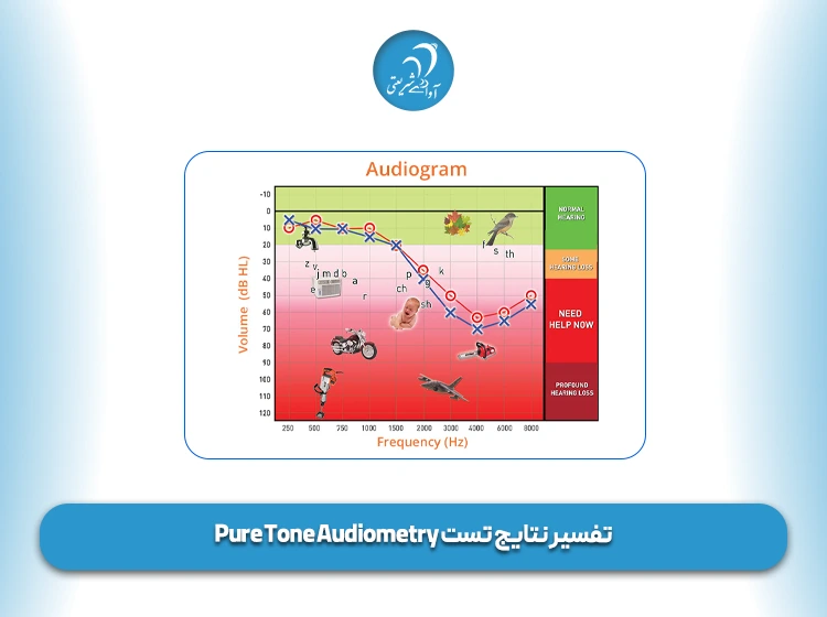 تفسیر نتایج تست Pure Tone Audiometry