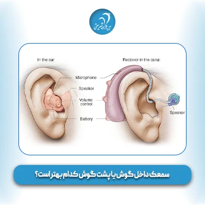 سمعک داخل گوش یا پشت گوش کدام بهتر است؟