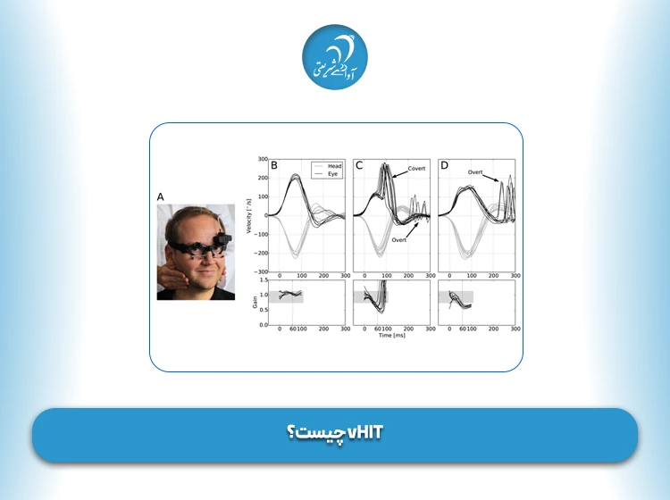 vHIT چیست؟